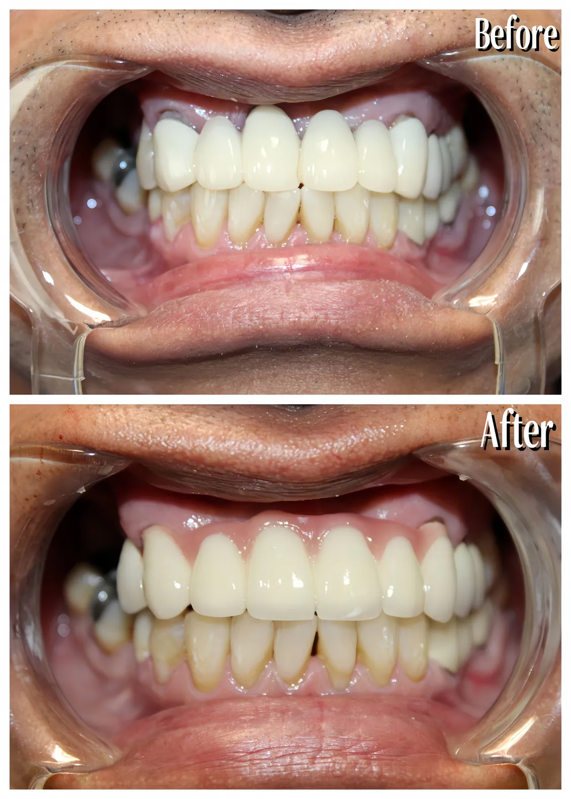 #5-12 bridge pre and post