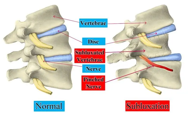 Subluxation diagram