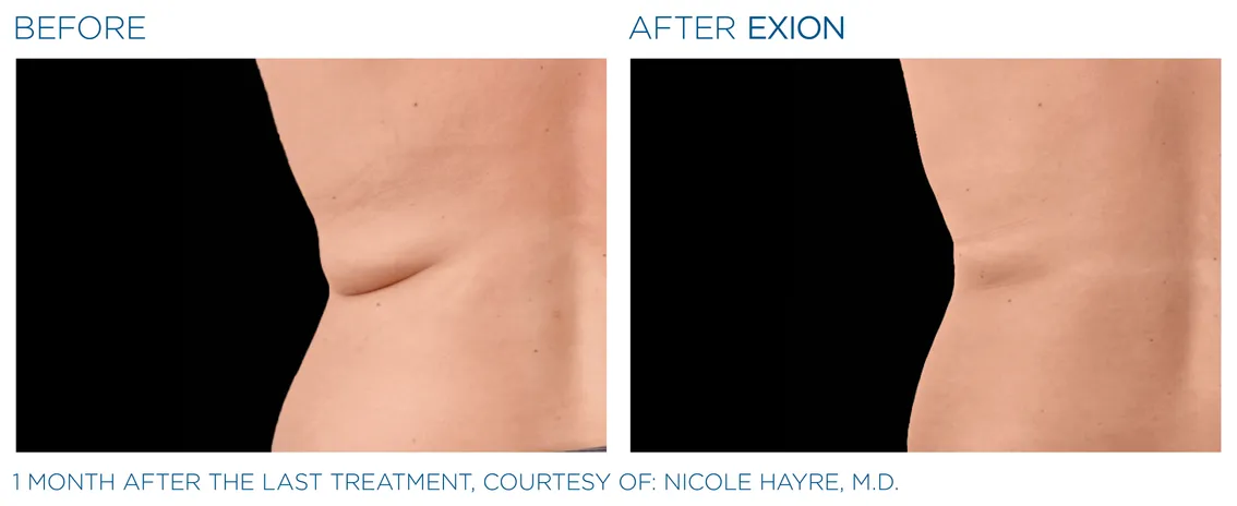 skin tightening treatment with exion in winter park, florida