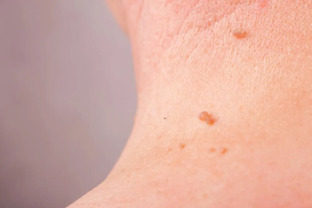 Skin tag in a person