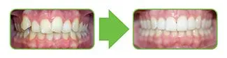 Clear Correct before and after | Fishers, IN Dentist