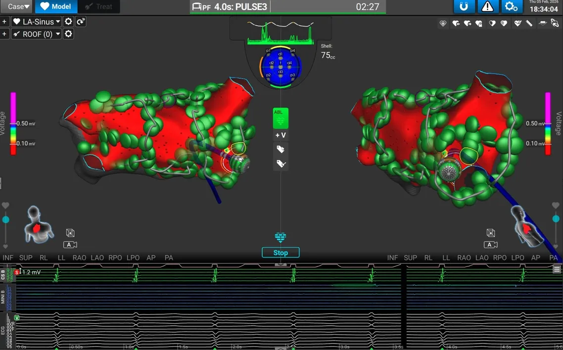 PVI PW ablation AFFERA