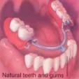 Dentures - The Dental Practice of Lincoln Park - Chicago, IL