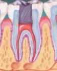 Root Canal Treatement - The Dental Practice of Lincoln Park - Chicago, IL