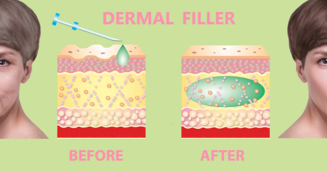 derma filter
