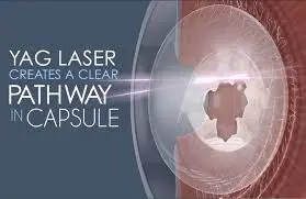 yag laser image