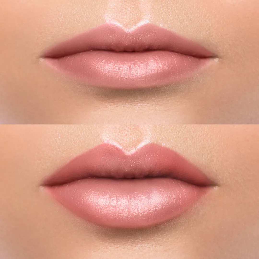 lip before and after