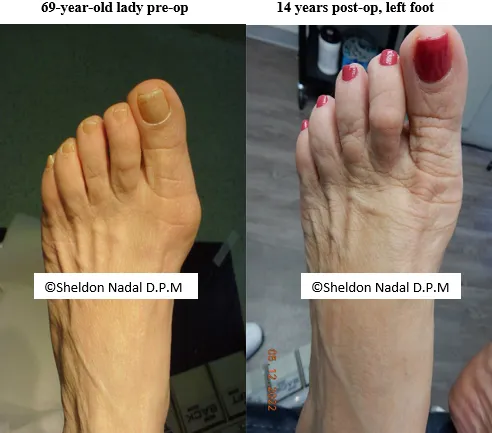 BEFORE &copy; Sheldon Nadal DPM AFTER