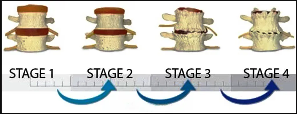 Degenerative Disc Disease