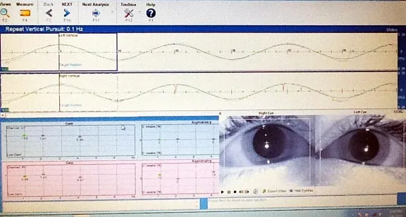 video nystagmography exam chart for tracking eye movement