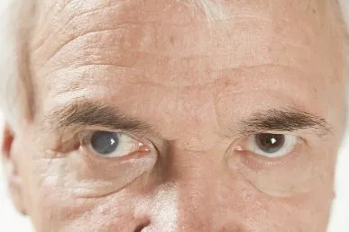 Senior man with cataracts