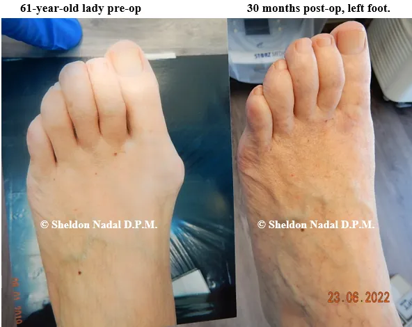 BEFORE &copy; Sheldon Nadal DPM AFTER