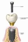 Dental Implant