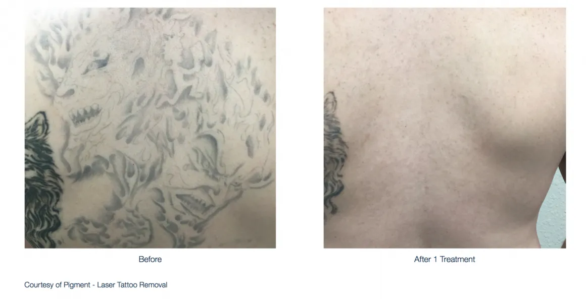 Tatoo Removal