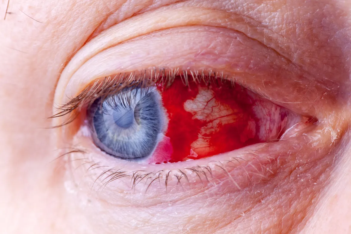 Common Eye Injuries