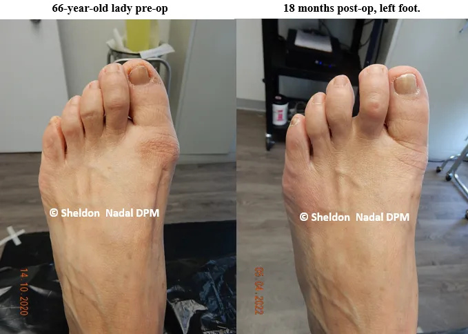 BEFORE &copy; Sheldon Nadal DPM AFTER