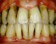 periodontis