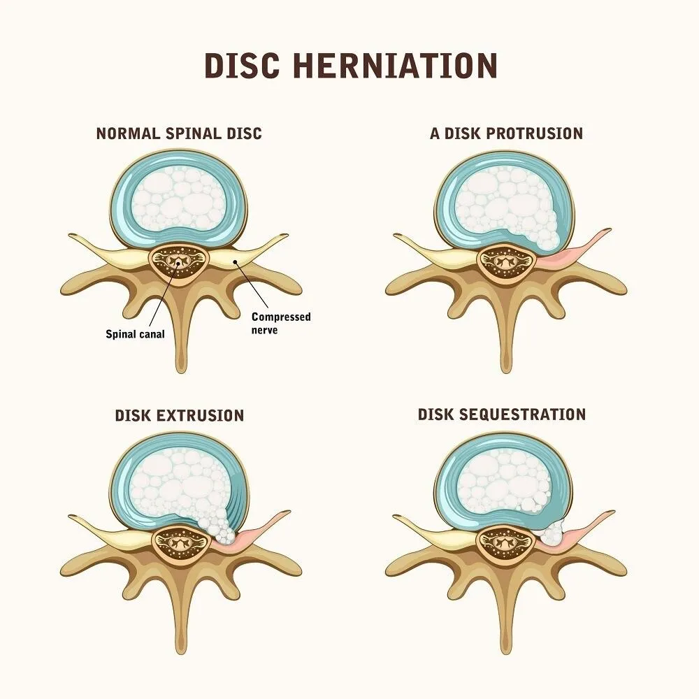 Disc Herniation