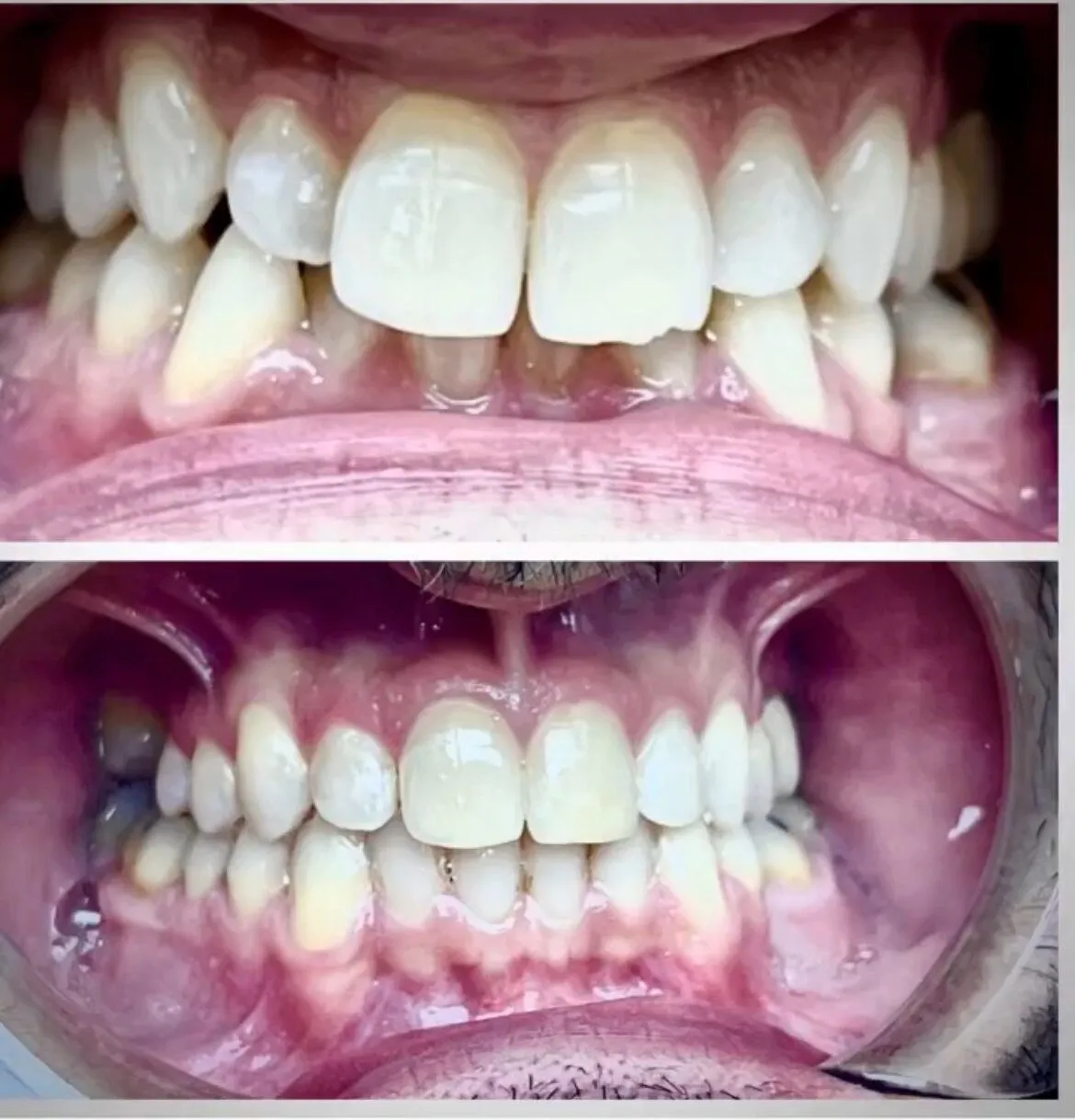 Invisalign Before and After