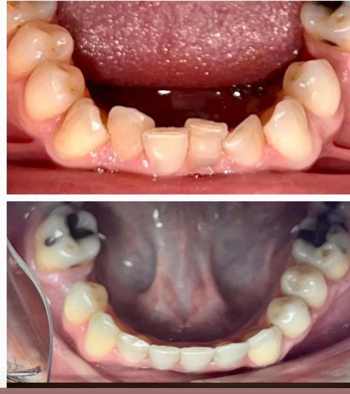 Invisalign Before and After