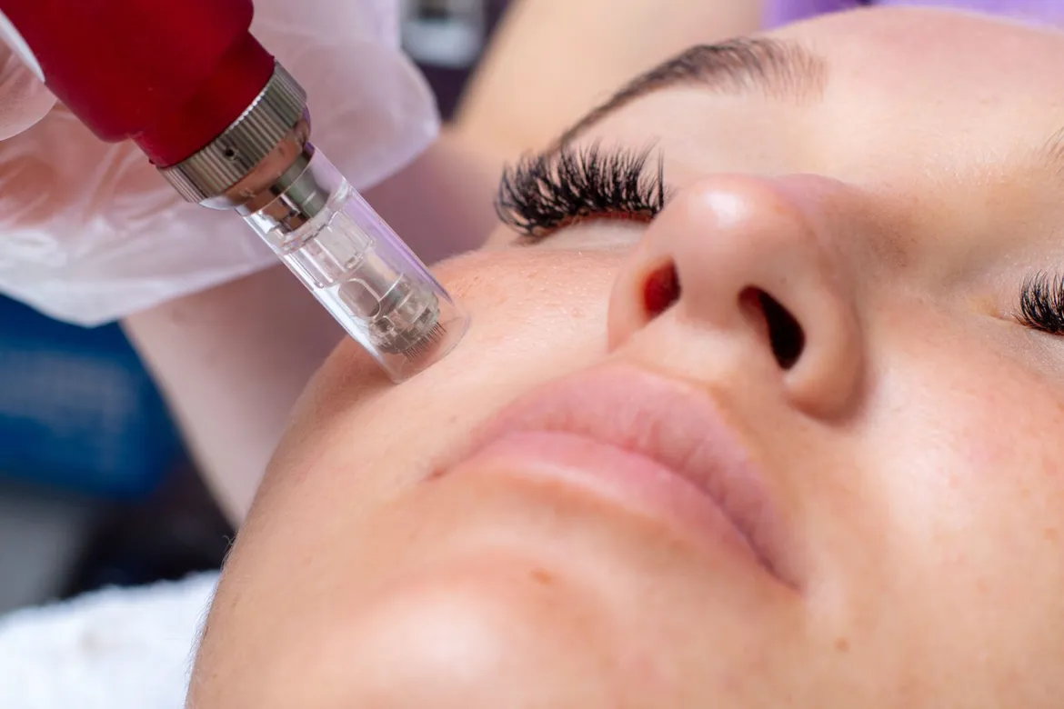 Microneedling in Issaquah, WA