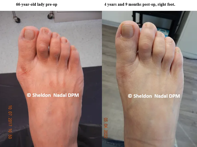 BEFORE &copy; Sheldon Nadal DPM AFTER