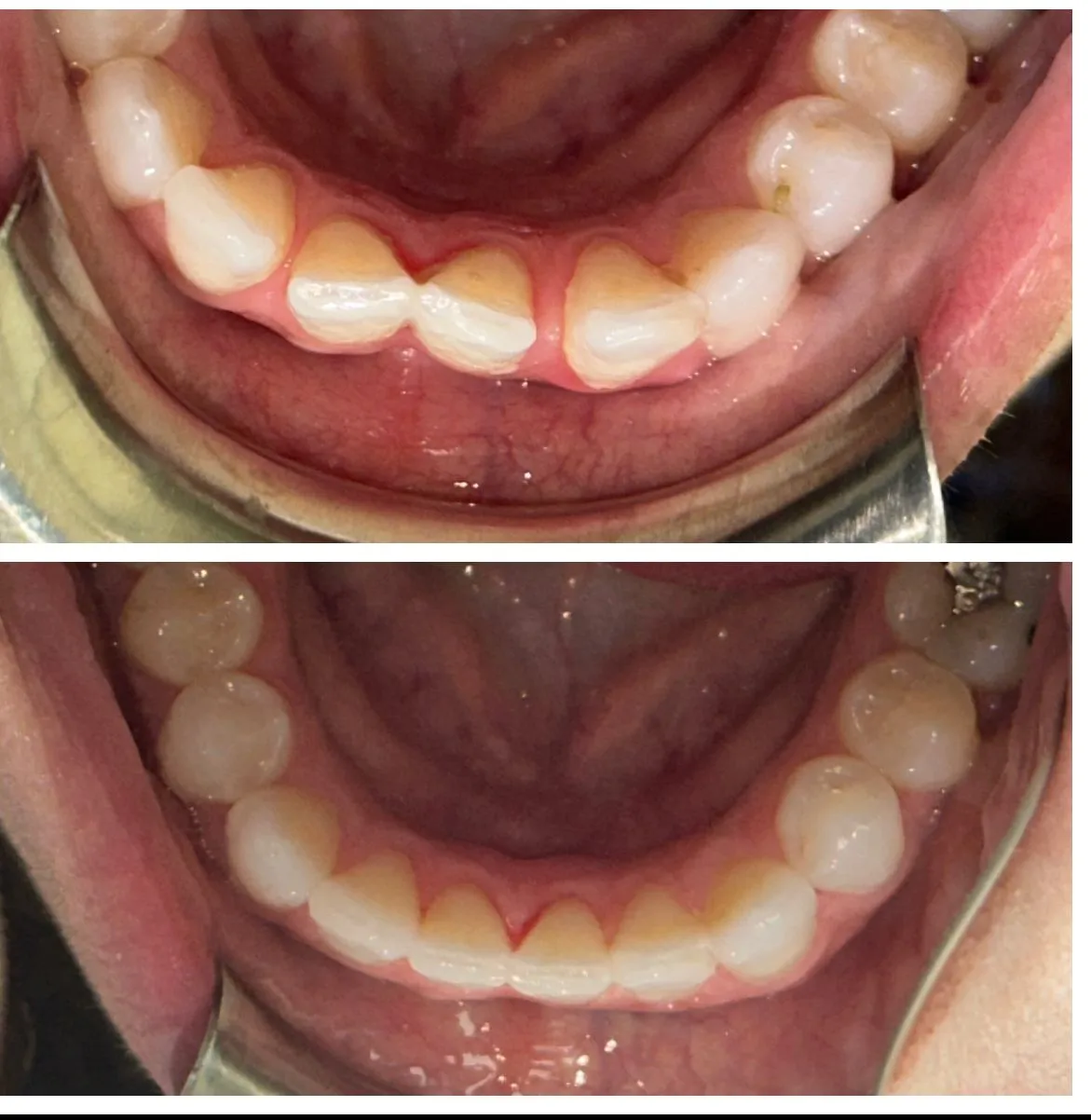 invisalign before and after