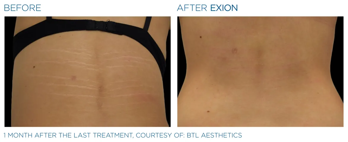 rf microneedling treatment with exion in winter park, florida