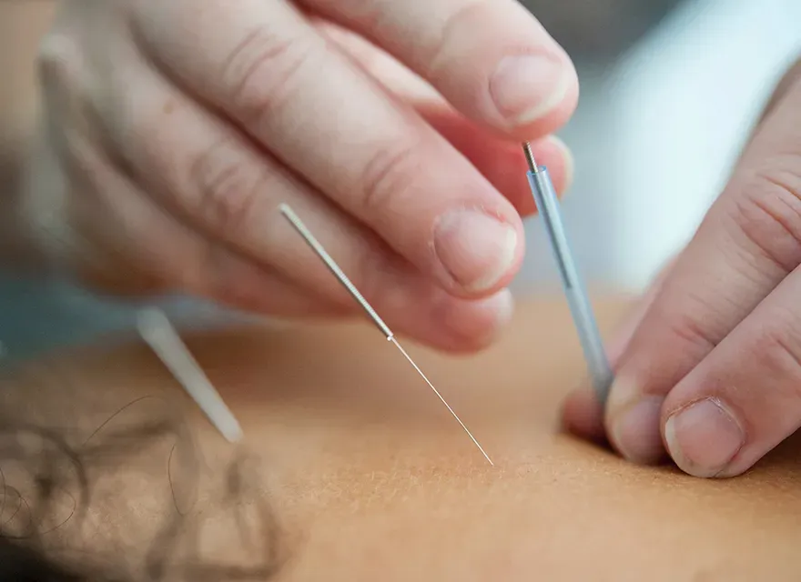 Acupuncture