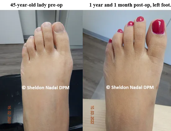 BEFORE &copy; Sheldon Nadal DPM AFTER