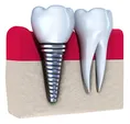 illustration of dental implant and crown screwed into gum next to natural tooth, dental implants in San Jose, CA