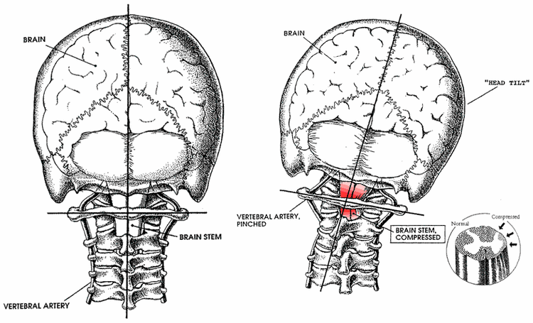 Needham Chiropractor | Needham chiropractic What is Atlas Orthogonal Upper Cervical Care? | MA |