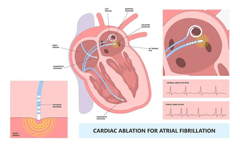 ablation for afib