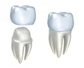 Dental Crowns and Bridges Easton MD