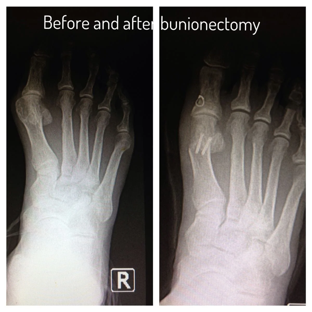 Right Foot Before & After Bunionectomy