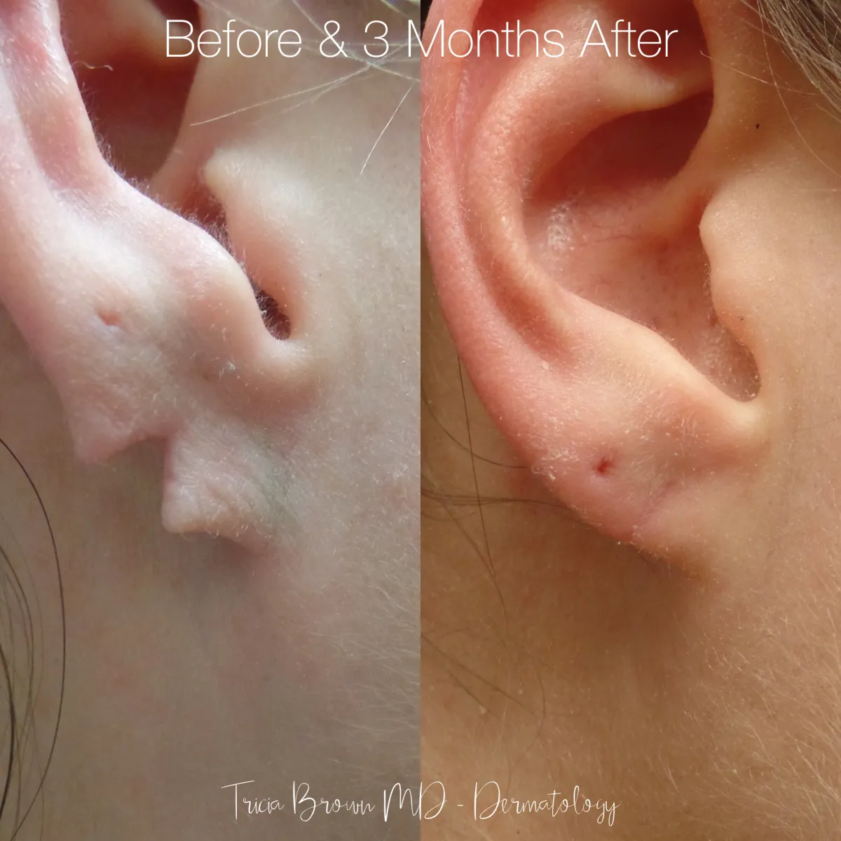 The Leading Experts in Earlobe Repair Advanced Liposuction Center.