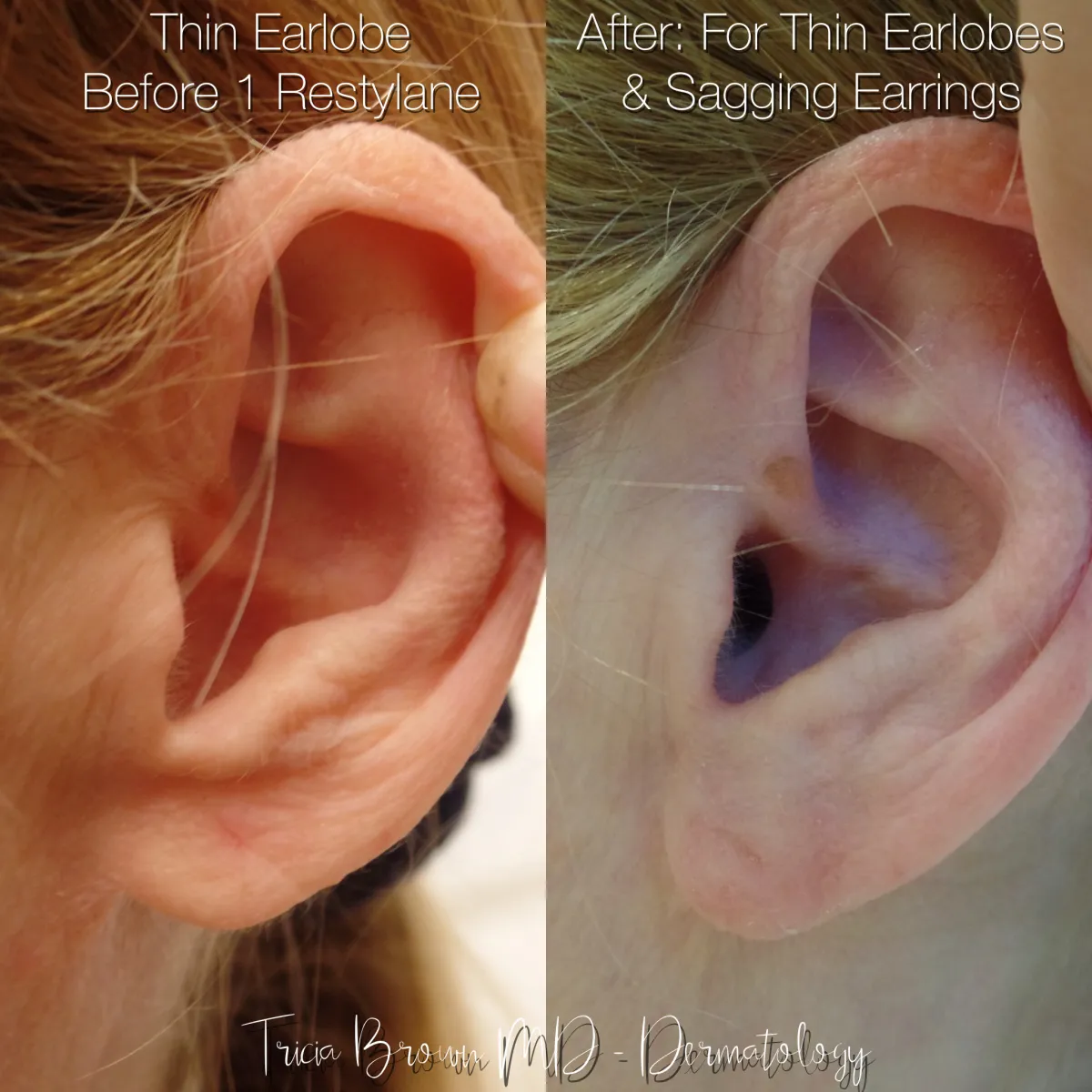 Repair of bat ears (otoplasty) and holes in ears and earlobe tears