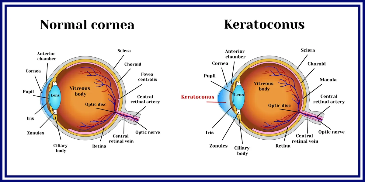 Corneal_Disease_FAQs