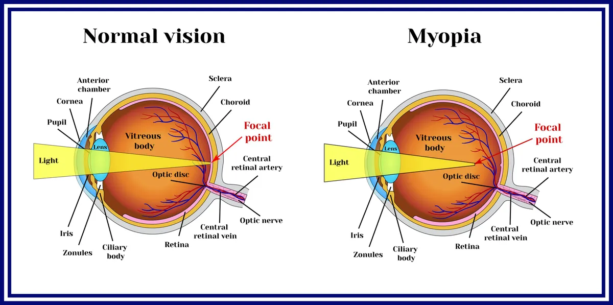 Myopia_FAQ