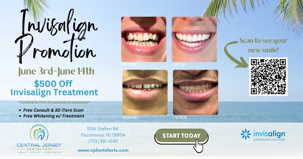 Invisalign summer promotion