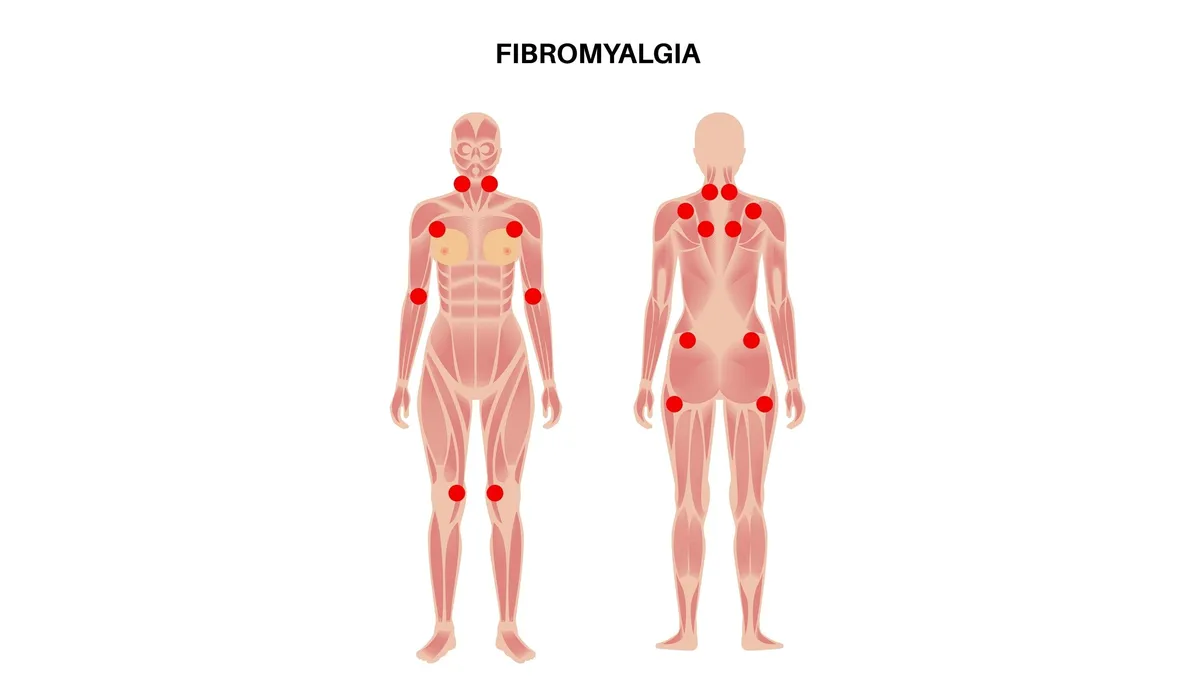 Fibromyalgia