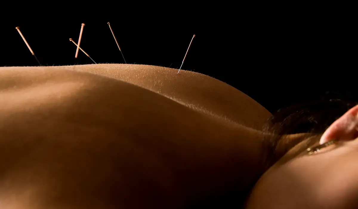 Acupuncture Needles in Person's Back
