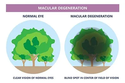 Macular Degeneration