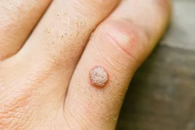 what causes warts