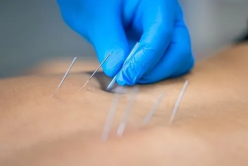 Acupuncture_back