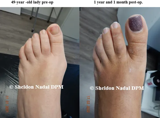 BEFORE &copy; Sheldon Nadal DPM AFTER