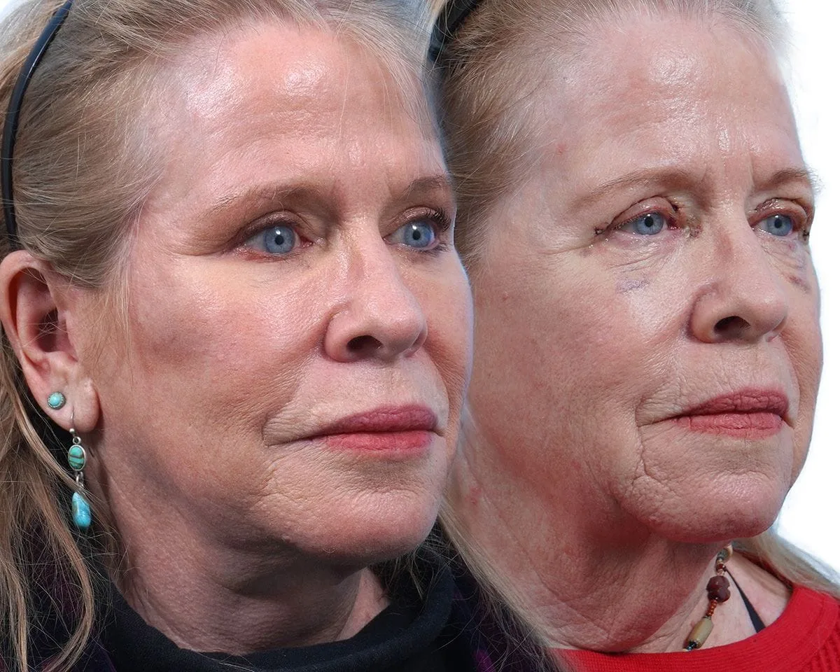Facelift results before and after image of a woman.