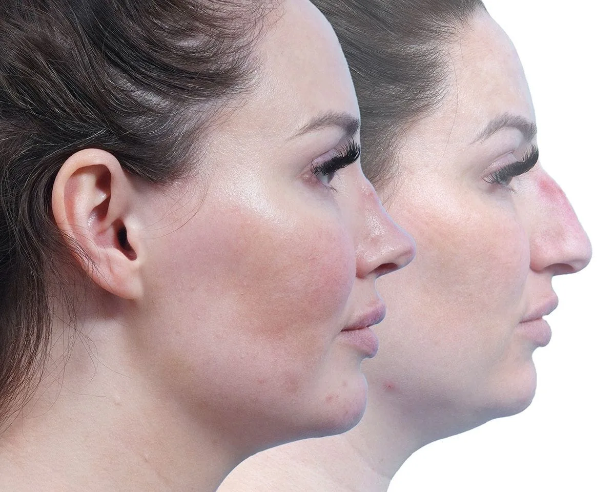 Rhinoplasty results before and after image of a woman.