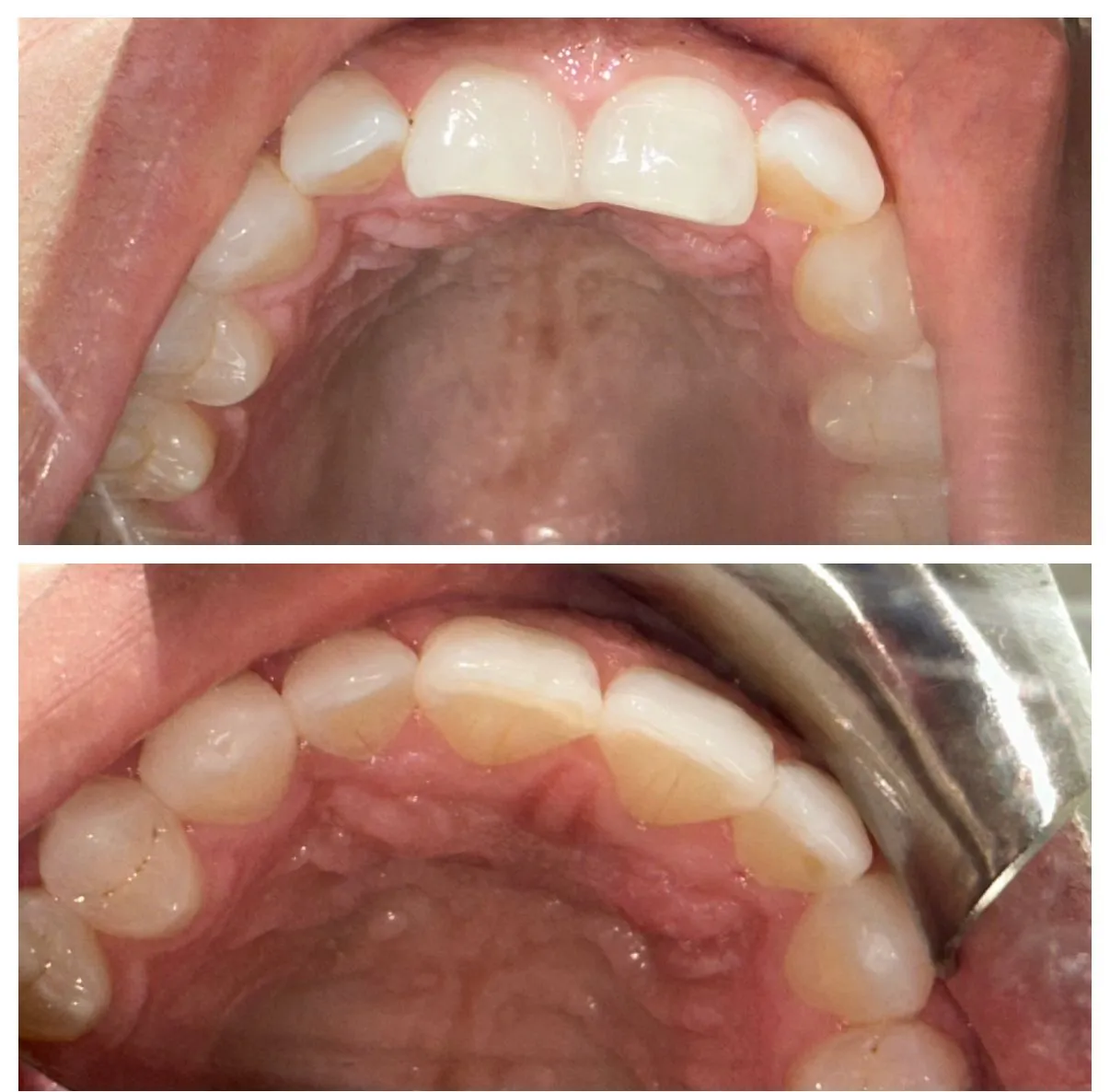 invisalign before and after