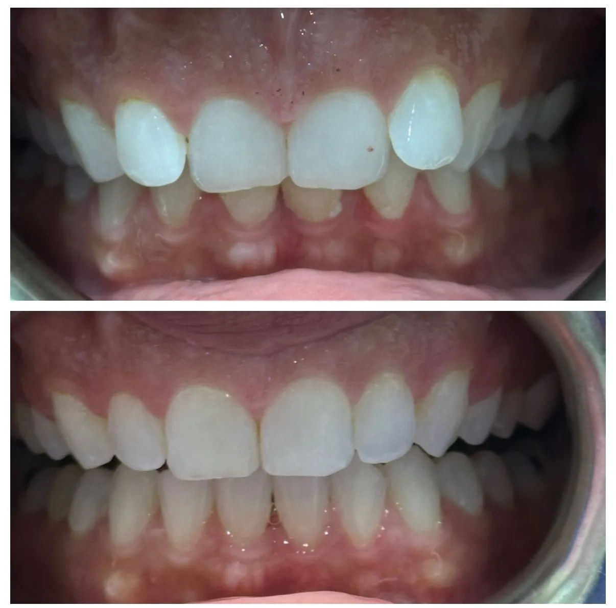 invisalign before and after